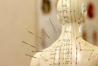 Acupuncture